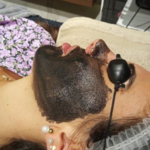 Hollywood Peeling : La técnica de rejuvenecimiento facial indolora